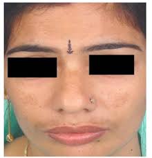 Melasma (Chloasma): Pathogenesis and Treatment