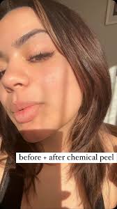 ᴄʜᴇᴍɪᴄᴀʟ ᴘᴇᴇʟꜱ- sounds scary right? NO! , Not all chemical peels result in  peeling, it really just depends