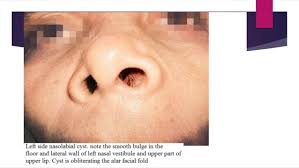 Definition, description, causes and risk factors: Diseases Of Nasal Vestibule