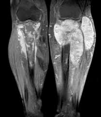 Has the cancer spread to other parts of the body? Linfoma Primario Oseo Multifocal Reporte De Caso Y Revision De La Literatura Sciencedirect