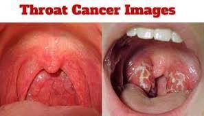 Your partner can catch it from you. Human Papillomavirus And Throat Cancer Do I Have Hpv Throat Cancer