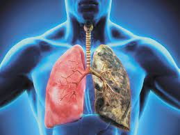 В Якутии началась кампания по профилактике рака лёгких — Новости Якутии и  Якутска — свежие новости на сайте ЯСИА | ЯСИА – новости онлайн