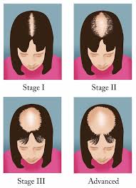 This type of hair loss is called androgenic alopecia (aga), also known as female pattern hair loss. Is Female Pattern Hair Loss Reversible Cyber Hairsure