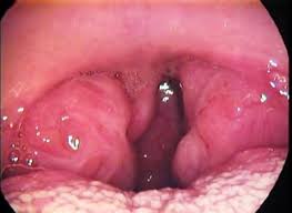 Fotos De Orofaringoscopia