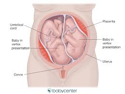 Jul 22, 2013 at 11:22 am. Fetal Presentation Of Twins Before Birth Babycenter