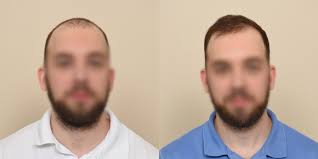 Top PRP Injections Providers in Madison, GA