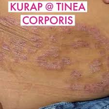 Related posts to ubat cap kaki tiga kurap. Kurap Marmin