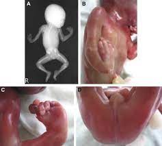 Vacterl Association With Hydrocephalus In A Fetus Conceived By In Vitro Fertilization And Embryo Transfer Sciencedirect