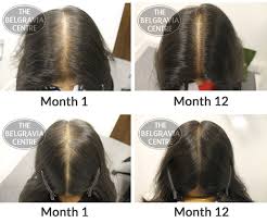 Women though, often notice a thinning in their bang area. Top Chat Show Host And Tv Doctor S Thinning Hair Tips For Women