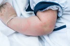 Cele mai comune alergii la bebelusi sunt produse de: Dermatita De Contact La Bebelusi Copilul Ro