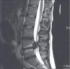 Cauda Equina Syndrome From Lumbar Disc Herniation Cauda Equina Cauda Equina Syndrome Magnetic Resonance Imaging