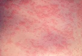 Image result for measles