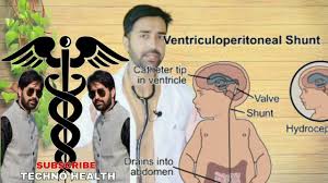 Vp Shunt Ventriculoperitoneal Shunt Treatment For Hydrocephalus Youtube
