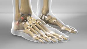 A weak, flat band that originates on the lateral malleolus of the fibula and extends anteromedially to the lateral side of the neck of the talus. Ankle Ligament Reconstruction Treating Chronic Ankle Instability Joint Surgeon Com