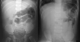 Image result for Adynamic Ileus