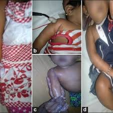 Check spelling or type a new query. Before Treatment A Waiter S Tip Position B Electrical Download Scientific Diagram