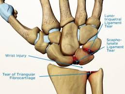 Image result for Scapholunate Dislocation
