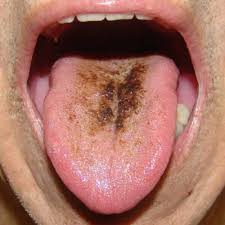 Image result for black hairy tongue symptoms