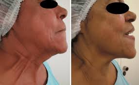 Before (left panel) and after (right panel) photos of a patient, with a... 