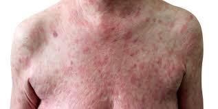 Image result for Lymphoma