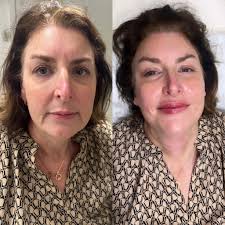 Today's transformation using a combination of dermal fillers and  polyneucleotides. Message to book. All clinics now held at Esthetic
