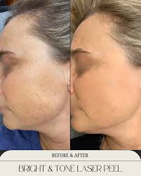 Incredible results achieved with our Bright & Tone Laser Peel treatment⚡️!  This advanced laser rejuvenating treatment combines 3 techniques using our  Lutronic Clarity platform: ・Alex Toning