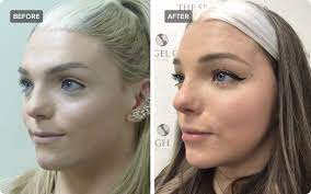 Facial Feminization Surgery: What You Need to Know | RealSelf