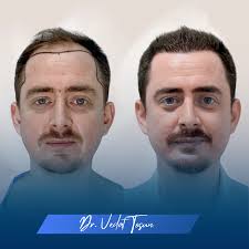 Leading Provider of Hair Transplantation Services in Turkey