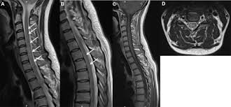 However ms can look like anything and may uncommonly involve the whole transverse diameter or only the anterior part. Longitudinally Extensive Transverse Myelitis Following Acute Covid 19 Infection Multiple Sclerosis And Related Disorders