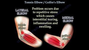 Created by and for tennis fans, tennis elbow 4 is the sequel of te2013, and offers a tennis simulation with an easy and intuitive learning curve, but with посетить сайт mana games в twitter managames на youtube просмотреть руководство просмотреть историю обновлений показать. Tennis Elbow Golfer S Elbow Everything You Need To Know Dr Nabil Ebraheim Youtube