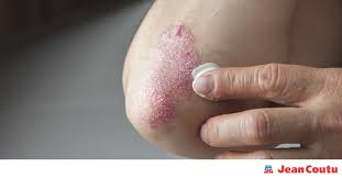 Le psoriasis est une maladie inflammatoire de la peau. Tour D Horizon Sur Le Psoriasis Jean Coutu