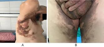 Image result for Diffuse Hyperpigmentation