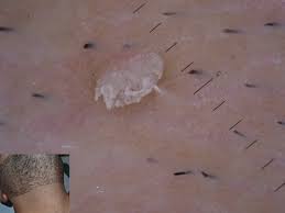 Image result for verrucae filiformes