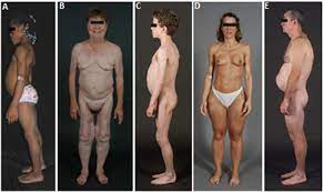 Patients are defective in the storage of body fat and. Lipodystrophy Syndromes Abstract Europe Pmc