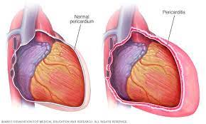 Learn the symptoms, causes, diagnosis and treatments for this condition. Pericarditis Symptoms And Causes Mayo Clinic