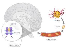 Image result for Cachexia in Cancer