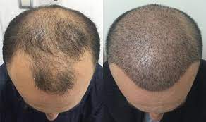 تكلفة زراعة الشعر في تركيا class hair