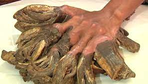 Tree man syndrome is a very rare disease, but it is very much real. Tree Man Of Bangladesh Desperate To Have Hands Amputated To Rid Him Of Bark Like Growths