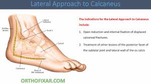 Image result for Calcaneus