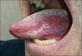 Image result for lichen planus on tongue)