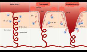 Factors indicating moderate risk are: Preeclampsia And Eclampsia Core Em