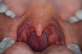 The most common symptom of esophageal cancer is a problem swallowing (called dysphagia). Hpv Throat Cancer Risk Factors Symptoms Treatment And More