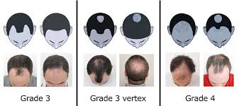 Allowing you to judge the results of your transplant in full. Grade 3 Grade 3 Vertex Grade 4 Hair Loss Maral Hair