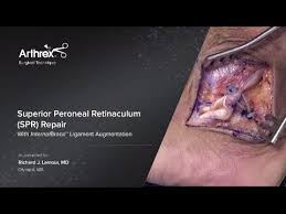 Tear of the superior peroneal retinaculum at its attachment to the distal fibula Superior Peroneal Retinaculum Spr Repair With Internalbrace Ligament Augmentation Youtube
