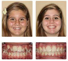 Gallery Orthodontist Mesa Gilbert Az Braces Treatment After Braces Orthodontics