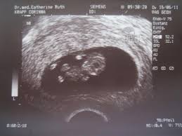 Ssw, formen sich beim embryo die gesichtskonturen, welche die augen, die augenlieder die noch zwischen beginn der 9. Bilder Aus Der Kategorie 10 Ssw Projekt Baby