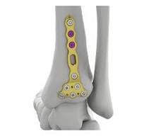 Itval Distal Posterior Tibial Locking Plate,Medical Device ...