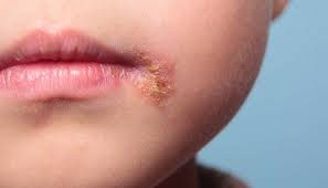 Cold sores are common and usually clear up on their own within 10 days. Can Babies Get Cold Sores Causes Treatment And Risks