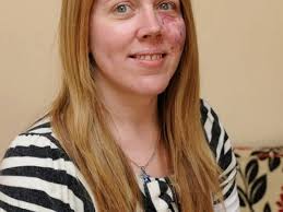 Brave mum Samantha Bohan tells how she stood up to the bullies who made her  life hell because of birthmark