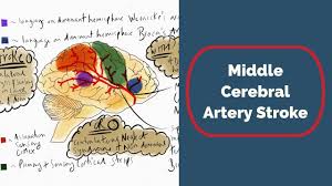 Stroke mechanisms and clinical features of anterior cerebral artery (aca) territory infarction have rarely been investigated using mri. Middle Cerebral Artery Stroke Youtube